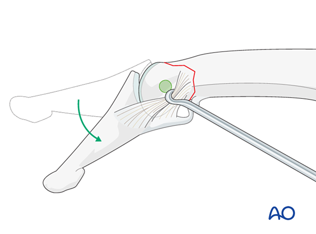 Lag-screw fixation of middle phalangeal head fracture. Flex DIP joint and retract collateral ligament palmar.