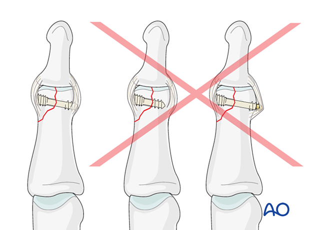 Lag-screw fixation of middle phalangeal head fracture. Use correct screw length to avoid soft tissue and neurovascular damage.