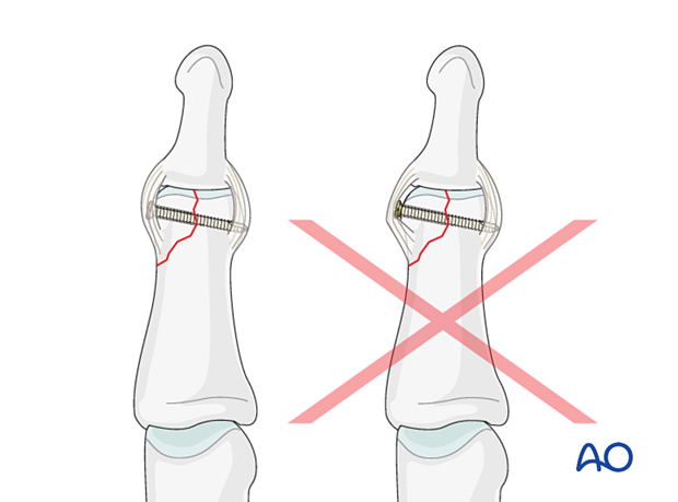 Lag-screw fixation of middle phalangeal head fracture. Enlarge screw hole entrance to sink screw head. Avoid overtightening to prevent fragmentation.