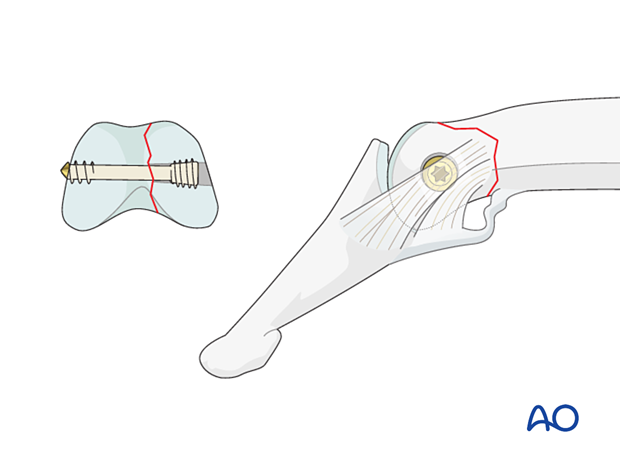 Lag-screw fixation of middle phalangeal head fracture. Insert headless screw and gently tighten to compress fracture.