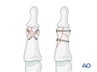 Lag-screw fixation of a complete articular fracture of the middle phalangeal head