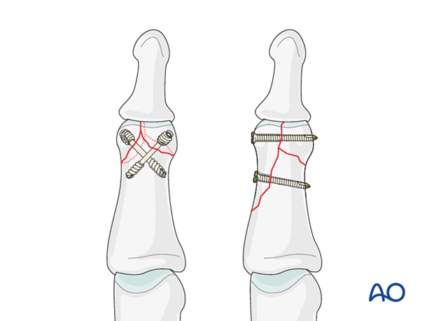 Lag-screw fixation of complete articular fracture of middle phalangeal head. Treat bicondylar fractures with open reduction and lag-screw fixation if fracture pattern allows. Fix articular fragments to main fragment.