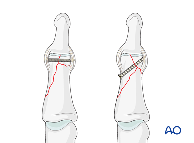 Lag-screw fixation of complete articular fracture of middle phalangeal head. Position distal screw based on fracture geometry. Insert transversely for vertical fracture plane, obliquely for oblique fracture plane.