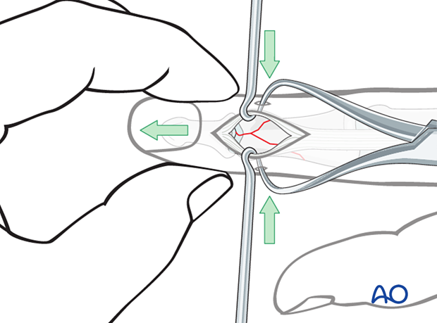 Lag-screw fixation of complete articular fracture of middle phalangeal head. Traction restores length. Lateral pressure reduces fracture. Confirm with image intensifier.