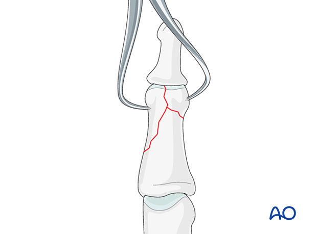 Lag-screw fixation of complete articular fracture of middle phalangeal head. Use pointed forceps to rock larger fragments. Confirm reduction with image intensifier.