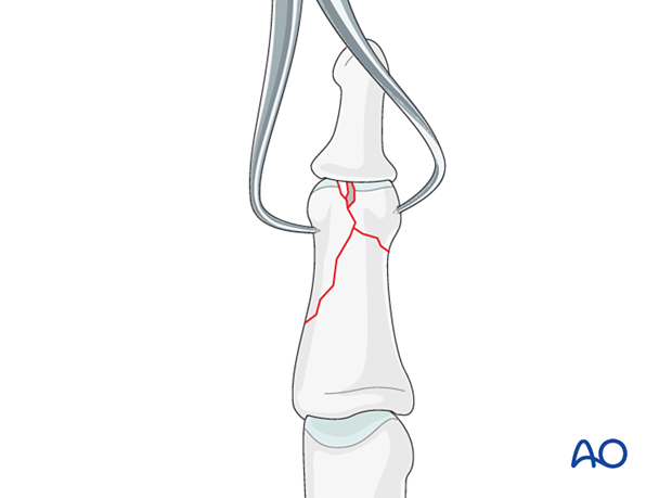 Lag-screw fixation of complete articular fracture of middle phalangeal head. Excise small intraarticular fragment if present. Removal precludes lag screw use between condyles.
