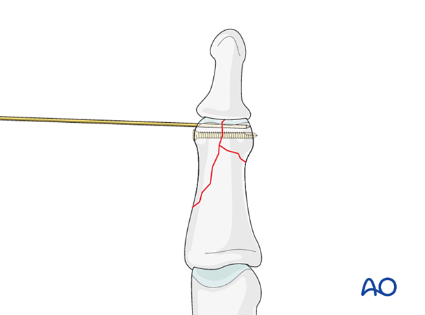 Lag-screw fixation of complete articular fracture of middle phalangeal head. Insert 0.8 mm K-wire deep to subchondral bone. Avoid small fragments and conflict with screw placement.