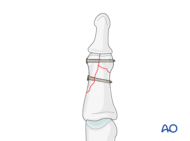 Lag-screw fixation of complete articular fracture of middle phalangeal head. Use 2-3 screws for larger fragment. Place screws proximal to collateral ligament. Evaluate x-rays and assess fracture plane and fragment size. Larger fragment must be at least twice the diameter of diaphysis for screw fixation alone.