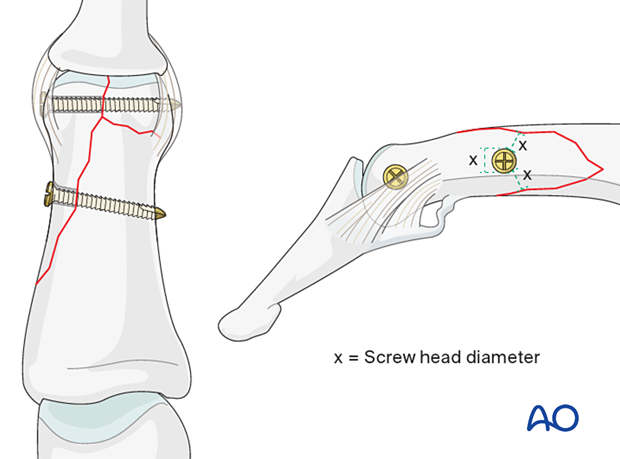 Lag-screw fixation of complete articular fracture of middle phalangeal head. Screw length must penetrate opposite cortex. Ensure minimal distance between screw head and fracture line. Choose smaller diameter screw if needed.