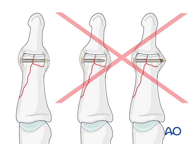 Lag-screw fixation of complete articular fracture of middle phalangeal head. Use correct screw length to avoid soft tissue and neurovascular damage.