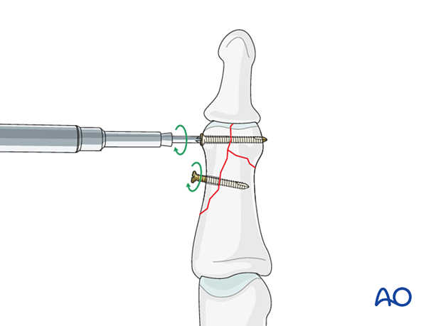 Lag-screw fixation of complete articular fracture of middle phalangeal head. Insert distal screw first. Alternate tightening to avoid tilting and ensure even compression.