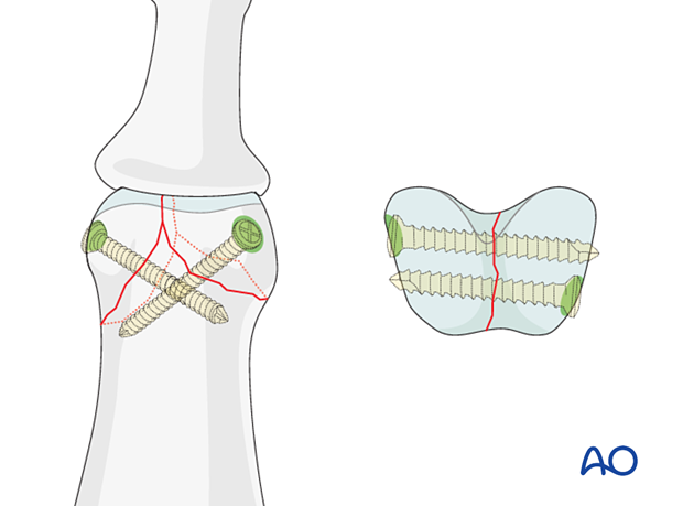 Lag-screw fixation of complete articular fracture of middle phalangeal head. Place screws through nonarticular face of condyles. Plan screw tracks in different planes to avoid crossing.