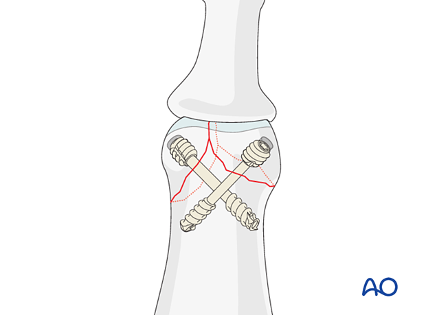 Lag-screw fixation of complete articular fracture of middle phalangeal head. Screw head should be subchondral or use headless screw.