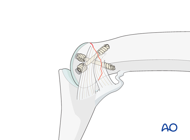Lag-screw fixation of complete articular fracture of middle phalangeal head. Approach lateral aspect by flexing PIP joint. Use headless cannulated screw to avoid ligament irritation and joint stiffness.