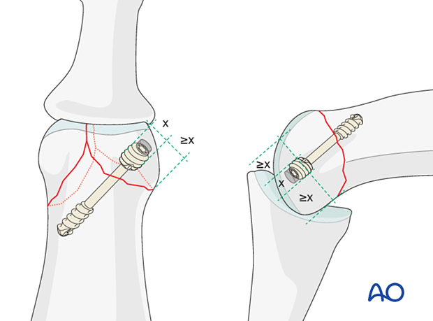 Lag-screw fixation of middle phalangeal head fracture, screw length adequate to penetrate opposite cortex.