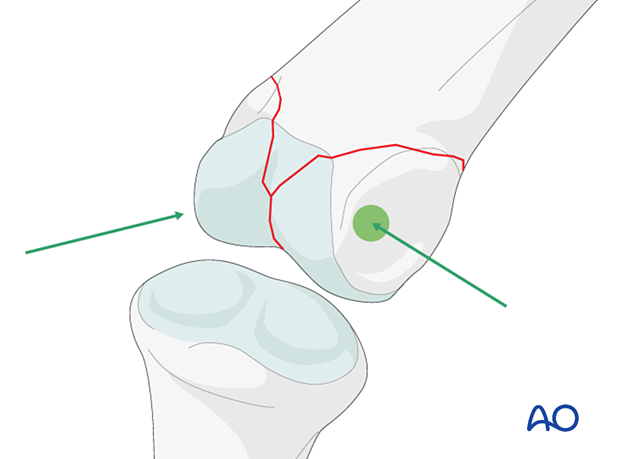 Lag-screw fixation of middle phalangeal head fracture, screws placed in ridges to avoid joint surface irritation.