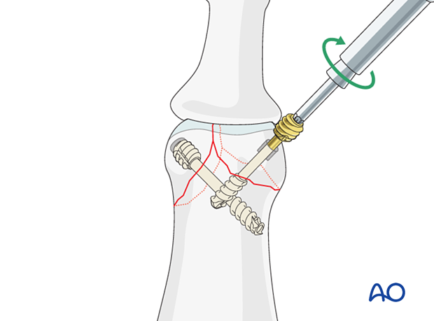 Lag-screw fixation of middle phalangeal head fracture, insert headless screws and gently tighten to compress.