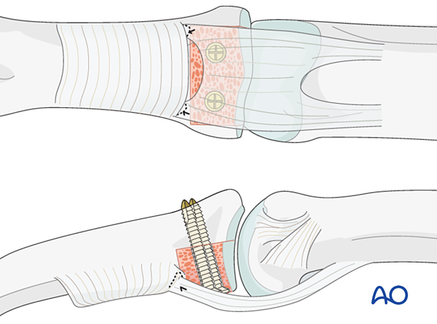 Hemihamate arthroplasty with osteocartilaginous graft; performed if >50% of palmar articular surface is affected.