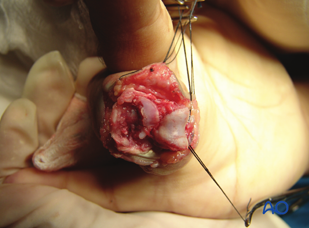 Hemihamate arthroplasty with osteocartilaginous graft; fracture comminution often determined under direct vision.
