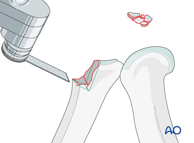 Hemihamate arthroplasty with osteocartilaginous graft; remove fragments, create box with rongeur, scalpel, and saw for graft.