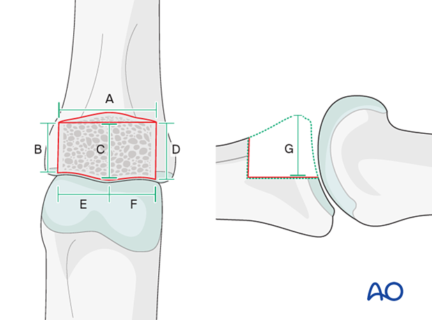 Hemihamate arthroplasty with osteocartilaginous graft; measure the box carefully in all dimensions.