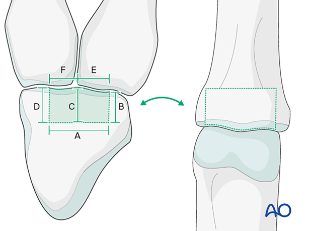 Hemihamate arthroplasty with osteocartilaginous graft; hamate's distal articular surface resembles middle phalanx base.