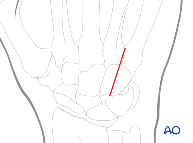 Hemihamate arthroplasty with osteocartilaginous graft; 2 cm incision at bases of 4th and 5th metacarpal, protect veins and nerve.