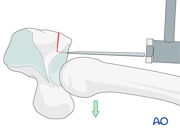 Hemihamate arthroplasty: Dislocate metacarpals palmarly and use chisel as lever to free graft fragment from hamate.