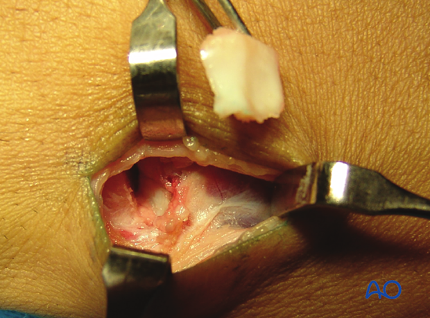 Hemihamate arthroplasty: Remove osteocartilaginous graft for reconstruction of palmar articular aspect of phalangeal base.