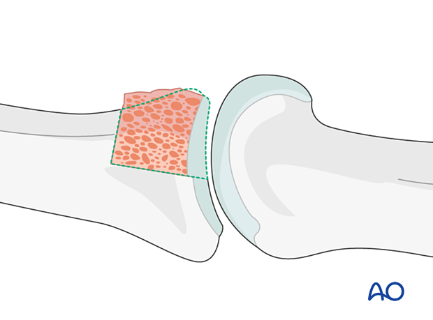 Hemihamate arthroplasty: Reduce joint to check congruency; confirm anatomical reconstruction with image intensifier.