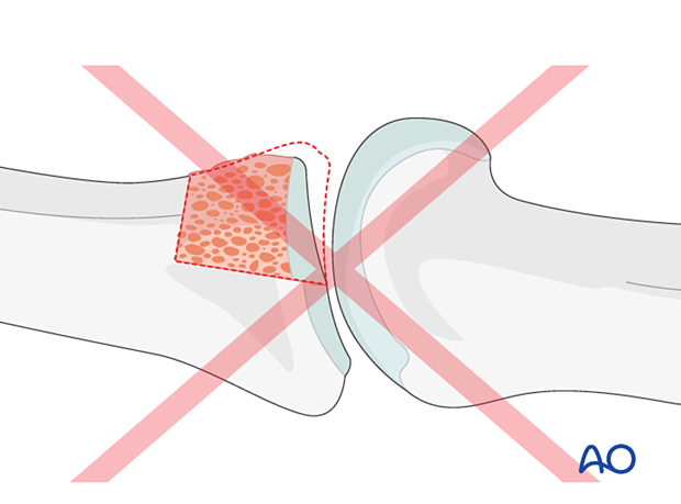 Hemihamate arthroplasty: Pitfall—Failure to recreate articular congruence may lead to joint dislocation.