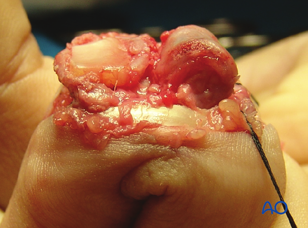 Hemihamate arthroplasty: Insert graft to reconstruct articular surface, adjust with rongeur for perfect fit without gap.