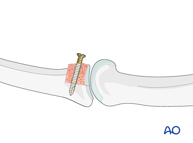 Hemihamate arthroplasty: Insert the first screw into the osteocartilaginous graft, but do not tighten it yet.