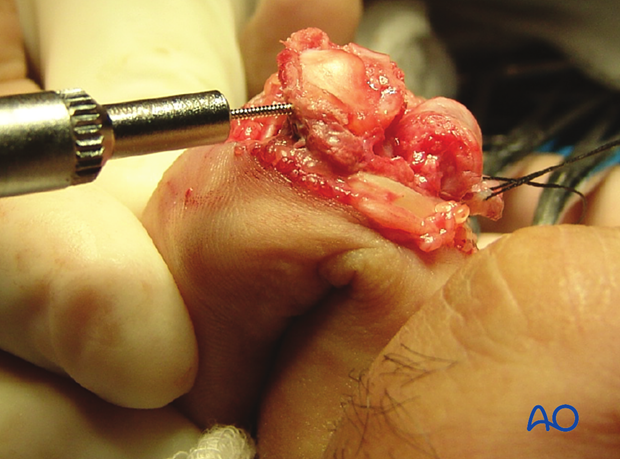 Hemihamate arthroplasty: Intraoperative photo showing insertion of the first screw into osteocartilaginous graft.