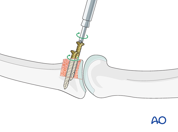 Hemihamate arthroplasty: Insert the second screw into the graft and tighten both screws alternately.