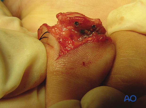 Hemihamate arthroplasty: Intraoperative photo showing both screws inserted into osteocartilaginous graft.
