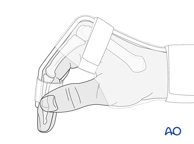 Hemihamate arthroplasty: Immobilize hand with dorsal splint for 4 weeks, PIP joint in 20–30° flexion, intrinsic plus position.