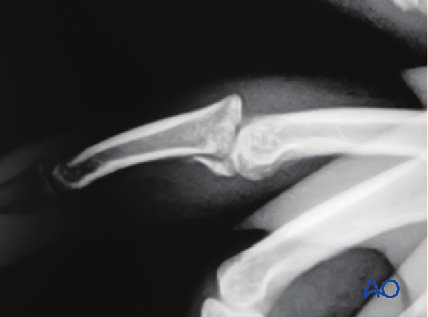 Hemihamate arthroplasty: Lateral x-ray showing palmar impaction fracture with over 50% articular surface involved.