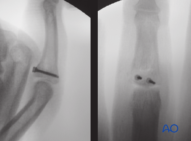 Hemihamate arthroplasty: Intraoperative views showing final construct of osteocartilaginous graft reconstruction.