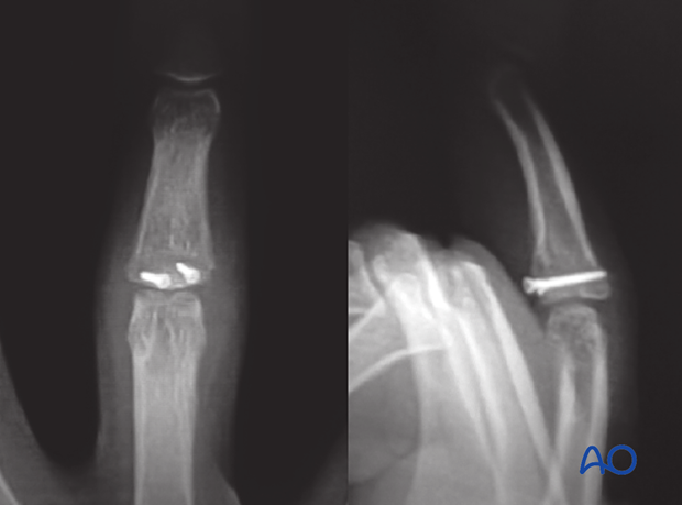 Hemihamate arthroplasty: X-rays showing fracture consolidation after reconstruction with osteocartilaginous graft.