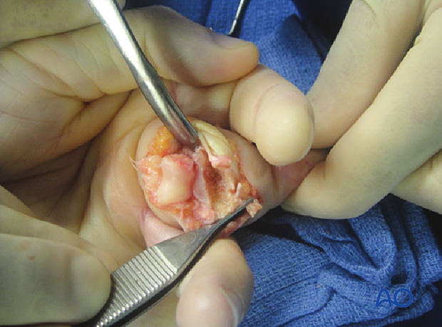 Hemihamate arthroplasty: Intraoperative photo showing middle finger in shotgun extension with box prepared for graft insertion.