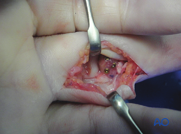 Hemihamate arthroplasty: Osteocartilaginous graft fixed with three screws to middle phalangeal base.