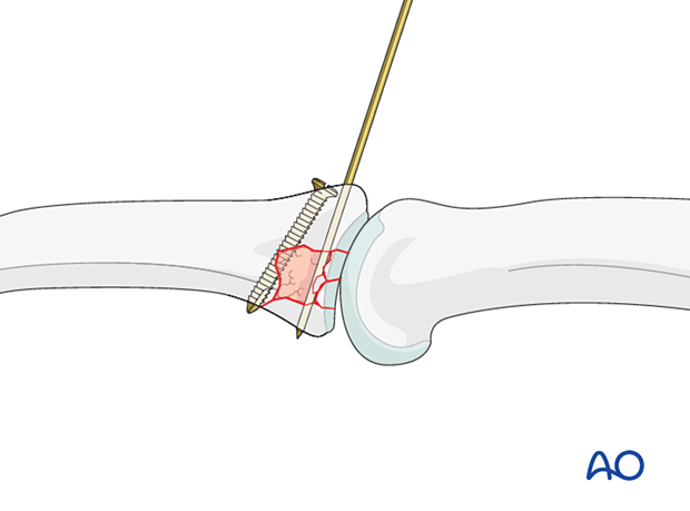 Joint reconstruction of palmar impaction fracture, reduction, bone graft, and subchondral screw insertion shown.