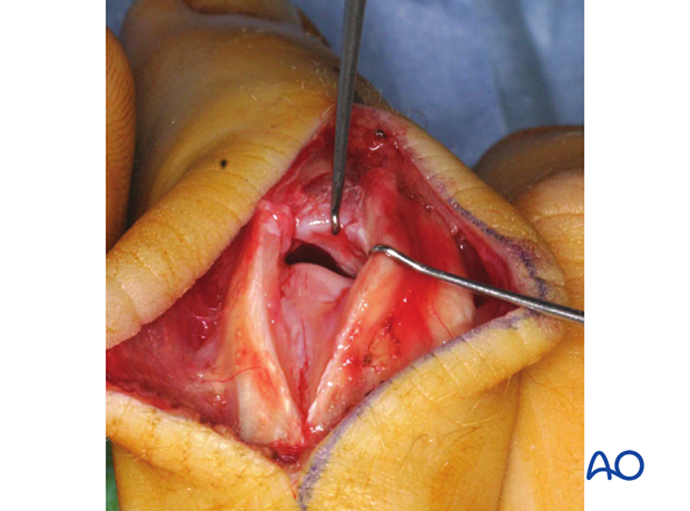 Joint reconstruction of palmar impaction fracture, comminuted palmar surface, bone grafting recommended.