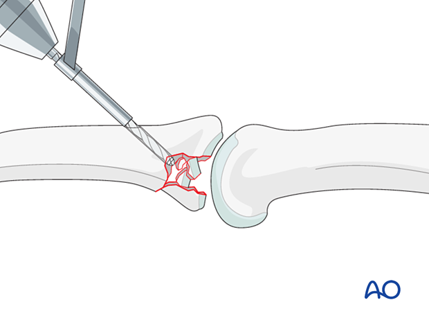 Joint reconstruction of palmar impaction fracture, create distal window with 1.5 mm drill bit for screw placement.
