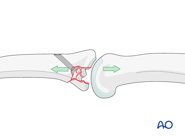 Joint reconstruction of palmar impaction fracture, direct reduction and bone grafting to restore joint surface.