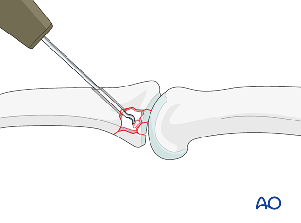 Joint reconstruction of palmar impaction fracture, disimpact fragments using needle or dental pick, ensure surface congruity.