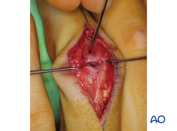 Joint reconstruction of palmar impaction fracture, intraoperative photo showing reduction with curette in cortical window.
