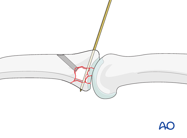 Joint reconstruction of palmar impaction fracture, insert K-wires from dorsal to palmar to stabilize reduction.