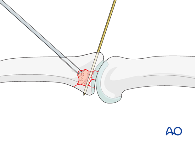 Joint reconstruction of palmar impaction fracture, use pusher instrument to fill fracture cavity, confirm reduction.